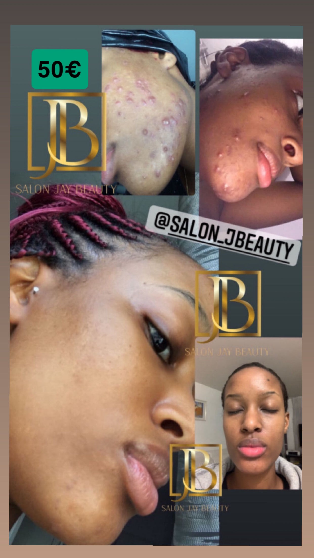 Crème anti boutons et taches