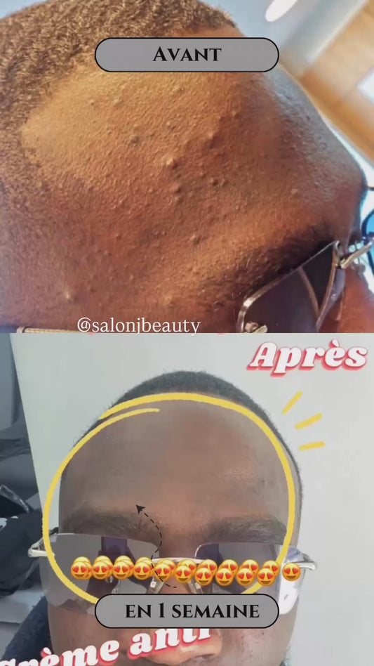 Crème anti bouton et tâche