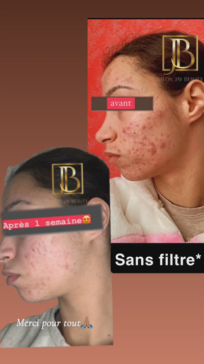 Crème anti boutons et taches